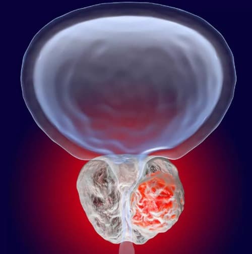 Prostatricum Preis